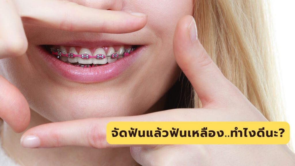 ทำให้ฟันขาวขึ้นหลังการจัดฟัน
