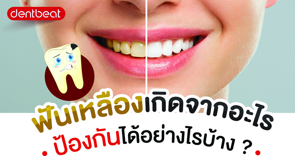 ฟันเหลืองเกิดจากอะไร ป้องกันได้อย่างไรบ้าง